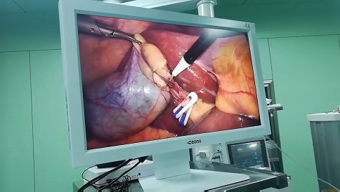 內(nèi)窺鏡攝像系統(tǒng)怎么選擇